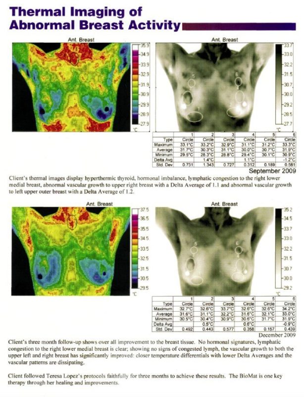 Thermal Imaging of Abnormal Breast Activity