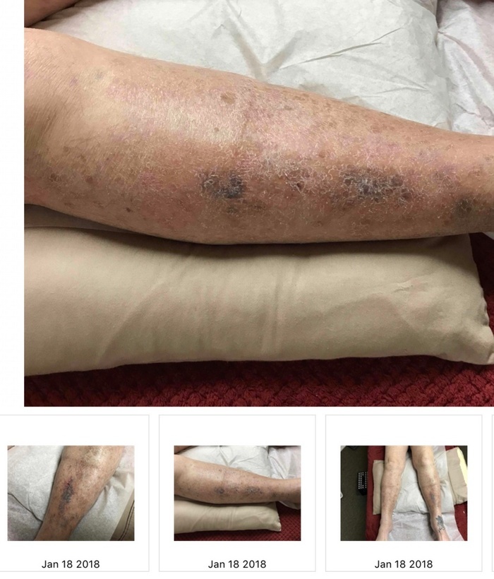 Skin condition - after one visit