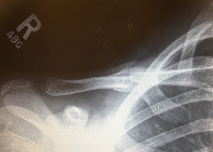 Collar bone fracture - after 3 weeks