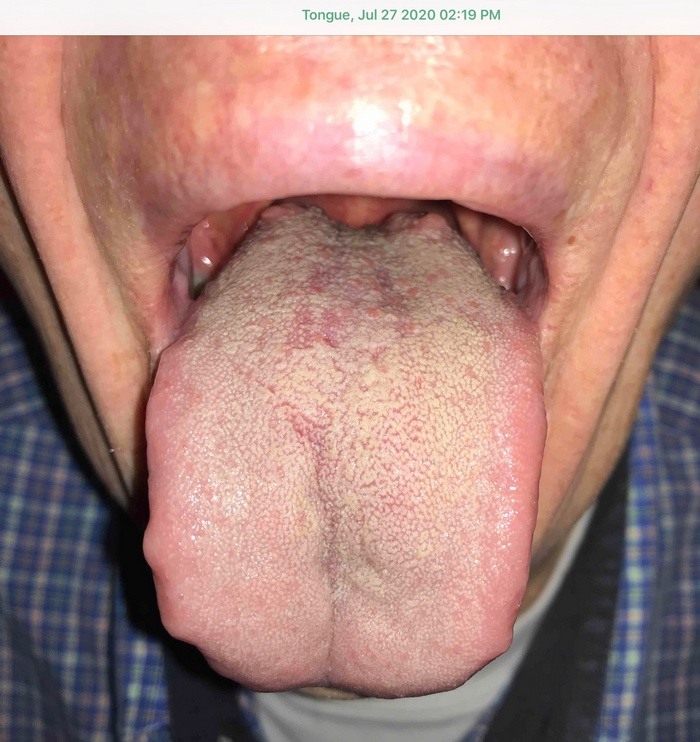 Tongue before treatment