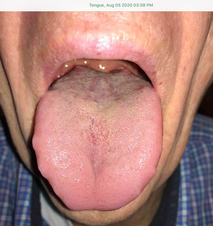 Tongue after treatment